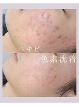 チュチュ(TUTU)/ニキビ、赤み