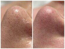 フェリス(FELIZ)/全顔丸ごと毛穴洗浄