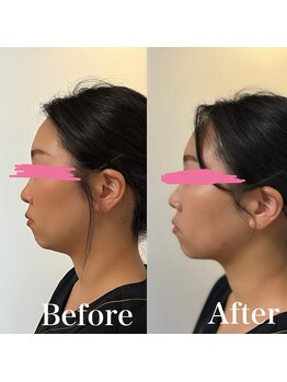 ホルバール 佐賀店(Hallbar)/小顔リフトアップマシーン