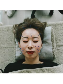 アキュネ 福岡薬院店(acune)/福岡/薬院/美容鍼/美肌