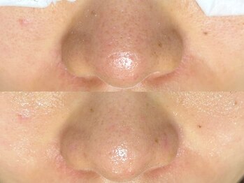 エクラ バイ シャンリィ(eclat by shanLy)/フェイシャルエステ