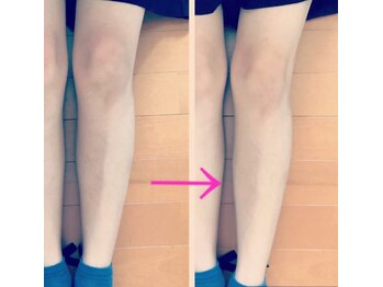 フェローズリンパケア(FELLOWS)/膝周り、お肉が乗っていませんか