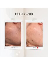 エクラ アン(eclat.un)/毛穴洗浄　40代：女性のお客様