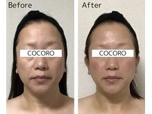 ココロ(COCORO)/小顔だけじゃなく凹凸ケアも
