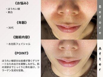 ルディラ医療提携エステ 立川店 毛穴/小顔/ニキビ・シミ・美白・シワ・たるみケア/水光肌フェイシャル