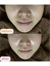 サクラ(SAKURA)/浮腫み知らずの小顔に♪