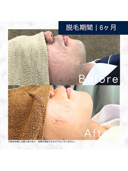 メンズクリア 松本店/【メンズクリア】お客様の施術例