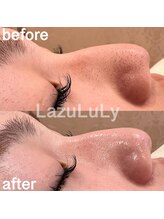 ラズリ(LazuLuLy)/毛穴の黒ずみ・つまりもごっそり