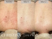 シェリーミル(Cherie Miru)/背中ニキビ/黒ずみ/くすみ