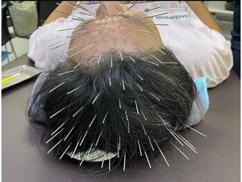 本八幡整骨院/女性鍼灸師によるルート鍼