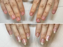 グラシュータン(gracieux temps)/深爪矯正