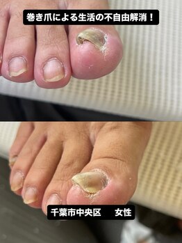 巻き爪じゅん 千葉駅前店/巻き爪で歩けなかった毎日を解消