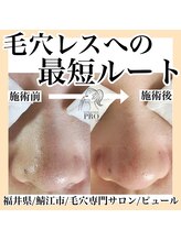 ピュール 鯖江店(PUR)/毛穴/毛穴ケア/毛穴洗浄