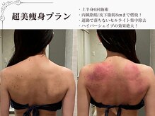 ラブミー 渋谷本店(LoveMe)/骨盤/ハイパーナイフEX/脇肉背中