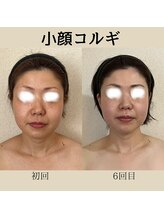 リーブル(LIBRE)/小顔コルギ　６回