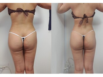 ソフィーム/全身痩身4回後 ヒップ太もも隙間