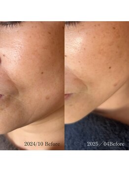 サロン ド エン(Salon de. en)/たるみケア◇ハーブピーリング