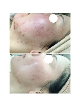 エヌエー(na)/肌質改善・ニキビケア・赤ら顔