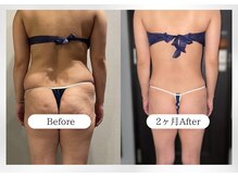 ガーネ 堺店(GARNE)/痩身・脂肪分解12回/20代後半