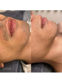 オンセ(once)/顔脱毛/全身脱毛