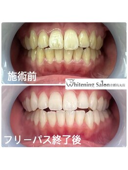 ホワイトニングサロン 京都烏丸店/ホワイトニング施術例