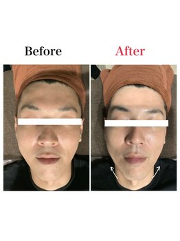 アネラ 燕三条/光フェイシャルBefore→After