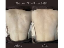 アイル(iru)/背中のハーブピーリング