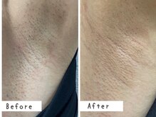 セルフメイド 高崎店(SELFMADE)/女性ワキ5回目ビフォーアフター