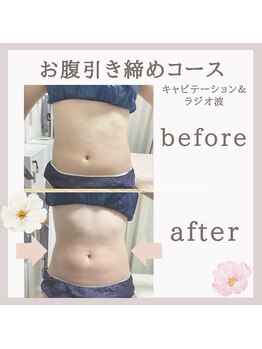 ビューティーフィール(Beauty Feel)/症例写真　痩身コース
