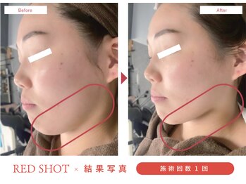 サバーイ サバーイ(SABAHI SABAHI)/【たるみ改善】半永久小顔形成