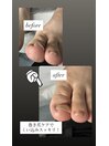 巻き爪緩和ケア