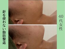 ソルニス(Solnis.)/小顔☆脂肪分解/ハイパーナイフ