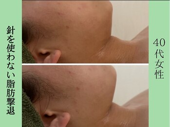 ソルニス(Solnis.)/小顔☆脂肪分解/ハイパーナイフ