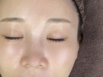 グラマー(Glamour)の写真/《ララピールの最新版≫剥離無し◎肌を育てるセラピール潤いと透明感が爆誕！！16500→11000韓国肌管理♪