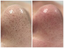 フェリス(FELIZ)/全顔丸ごと毛穴洗浄