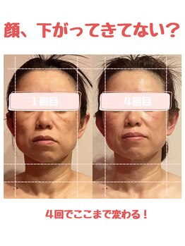 ビューティサロン キヨの部屋(beauty salon)/【筋膜リフティング】　４回