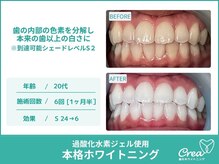 クレア(Crea)/【ホワイトニング症例写真】