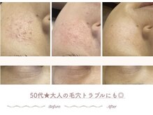 エステティックサロン シーズ/ 50代★赤み・毛穴の変化