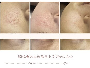 エステティックサロン シーズ/ 50代★赤み・毛穴の変化