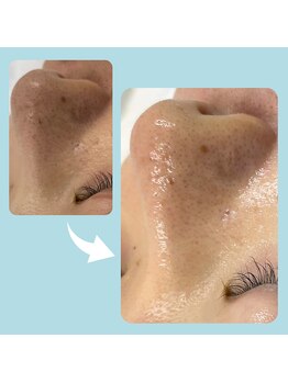 モイリープ(Moileep)/黒ずみケアもお任せ!