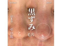 レディースシェービングサロン アール(R)の雰囲気（毛穴エクストラクションで毛穴の汚れも角栓もスッキリ♪）
