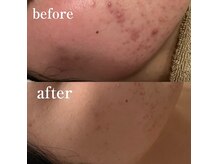 グリーンルーム(green room)/繰り返しのニキビケア3回