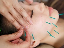 プライムライフ(prime-life)/美容鍼はリフトアップ即効性◎