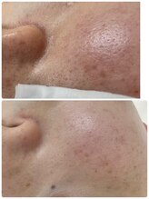 エステティック レイビス 秋田店(RAYVIS)/ＩＰＬフォト×ＩＰＬ顔脱毛