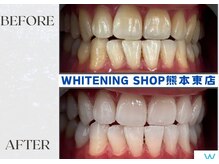 ホワイトニングショップ熊本東店/ホワイトニングショップ熊本東店