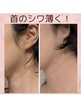 プライベートサロン 美月/シワ　エイジング