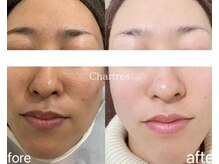 シャルトルズ 広島八丁堀店/《症例写真》