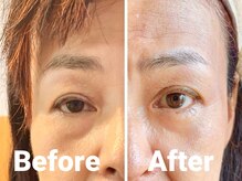 シャインアン(Shine'an)/小顔リフトアップ