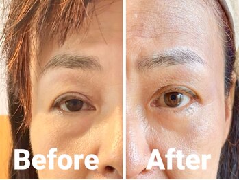 シャインアン(Shine'an)/小顔リフトアップ