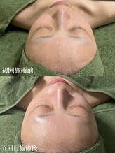 リーフィア(Leafia)/これぞ肌質改善☆